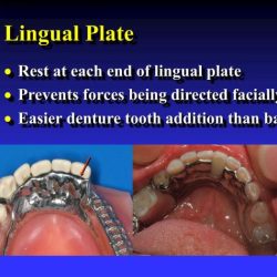 Lingual plate vs lingual bar