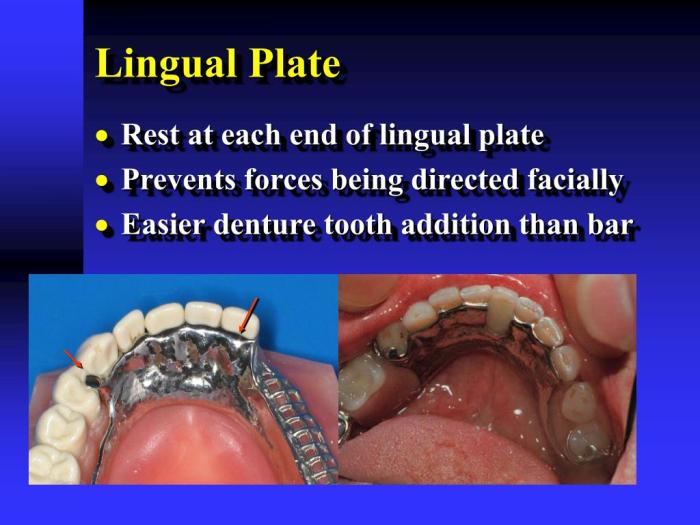 Lingual plate vs lingual bar