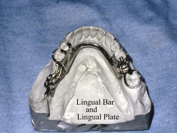 Lingual partial bar plate dentures removable clasp retained ppt powerpoint presentation