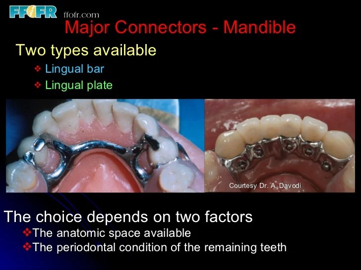 Lingual plate vs lingual bar