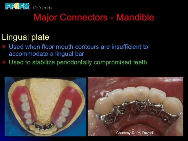 Connectors lingual junction